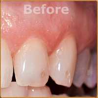 Beverly Hills Dentist Tooth Fillings